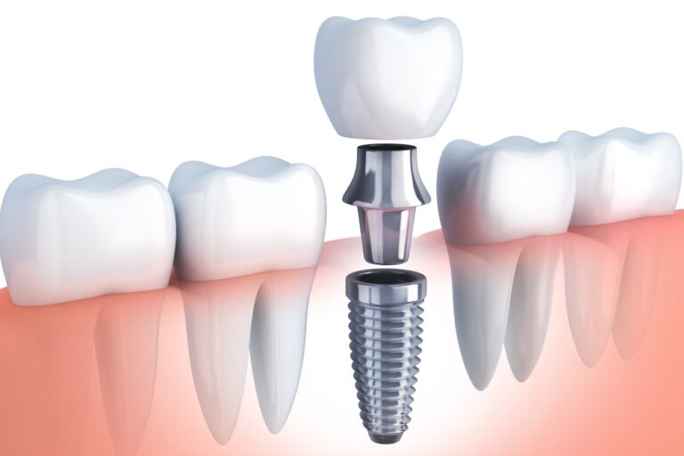 Upgrade Your Smile with the Best Dental Implants in Aberdeen
