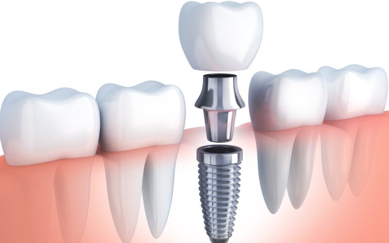 Upgrade Your Smile with the Best Dental Implants in Aberdeen