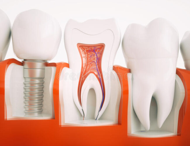 Expert Dental Implant in Aberdeen Solutions: Everything You Need to Know