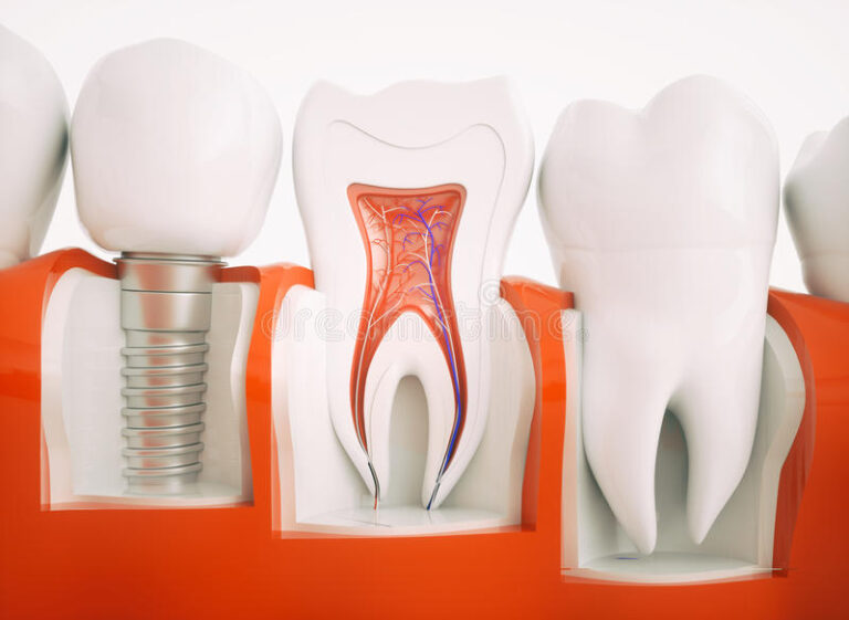 Expert Dental Implant in Aberdeen Solutions: Everything You Need to Know